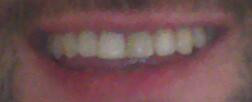 farbunterschied - (Zähne, Zahnarzt, Zahnkrone)