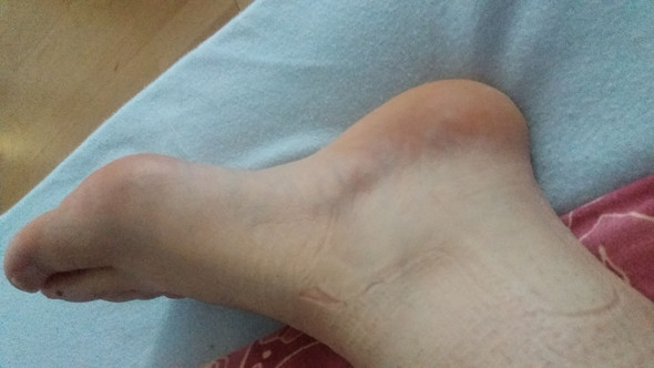 Ich Habe Mein Fuss Umgeknickt Was Soll Ich Jetzt Machen Gesundheit Fusse