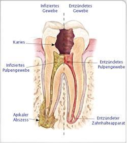  - (Schmerzen, Zahnarzt, Wurzelkanalbehandlung)