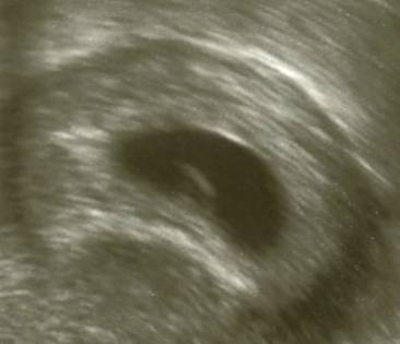 Wann Sieht Man Embryo Schwanger Ultraschall