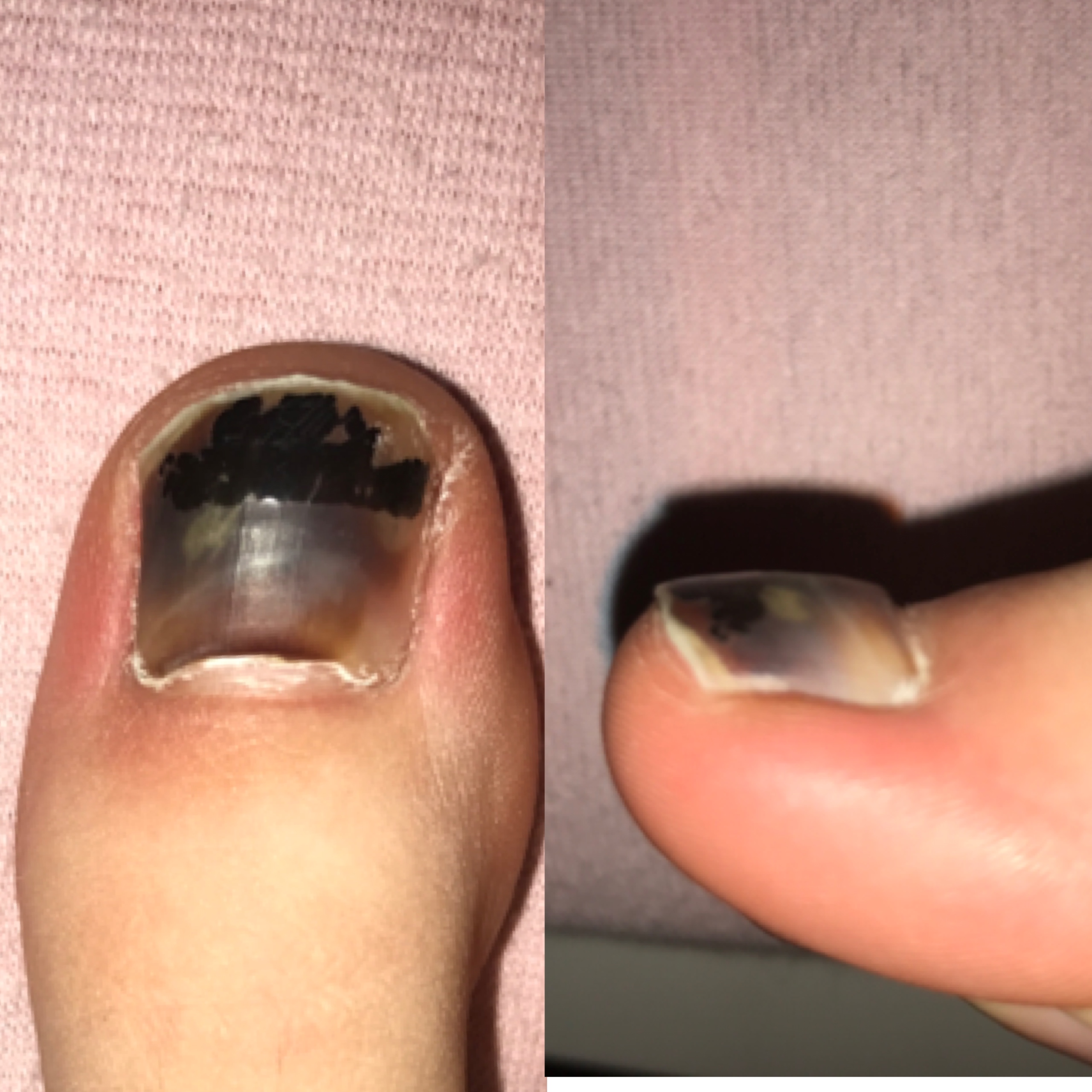 Blauer Zehnagel wächst komisch? (Füße, Nägel, blau)