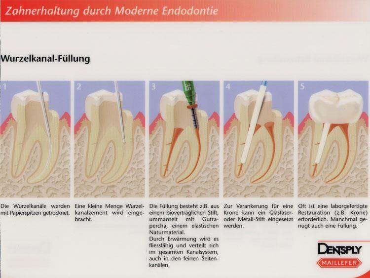 Wurzelbehandelter Zahn komisches Gefühl normal? (Gesundheit, Zähne, Wurzelkanalbehandlung)