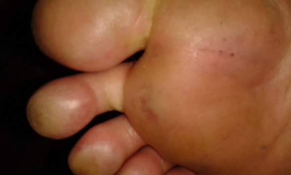 Fuss Brechen Mit Wasser Fusse Kaltes Wasser Fuss Brechen Mit Wasser Fusse Kaltes Wasser