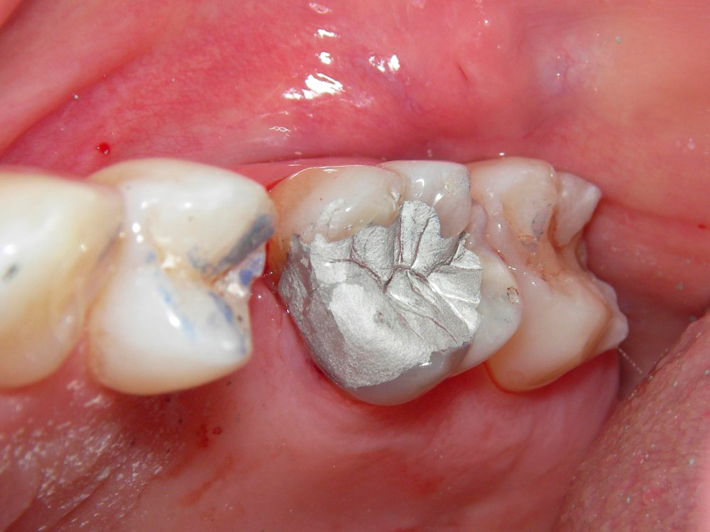 Zahnfüllung kratzt? (Arzt, Schmerzen, Zähne)