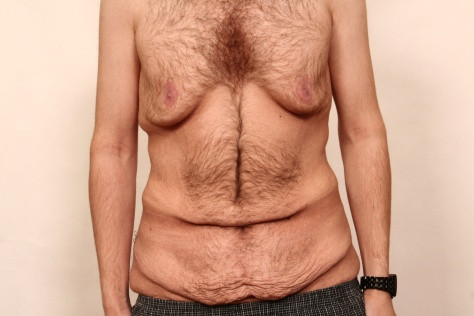 30 Kilo In 6 Monaten Sport Abnehmen Haut