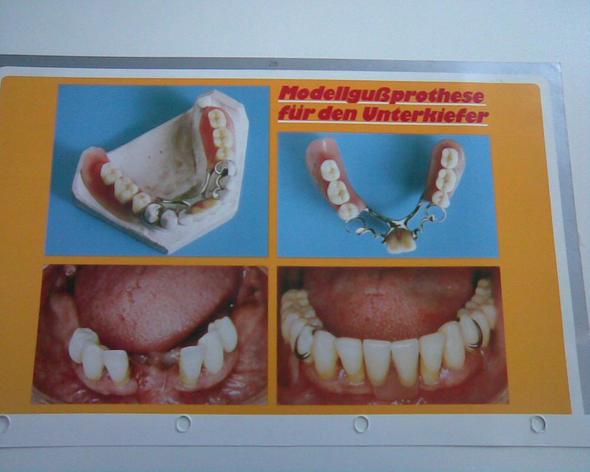 Modellgussprothese - (Zähne, Zahnarzt, Zahnersatz)