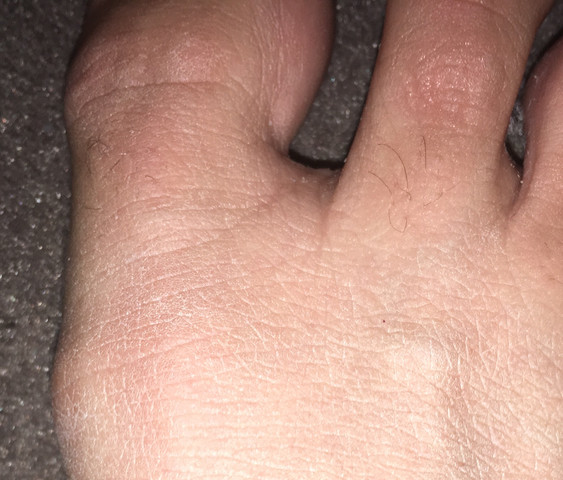 Ich fühle mich so unwohl - (Hallux Valgus, grosser-zeh, Hallufix)