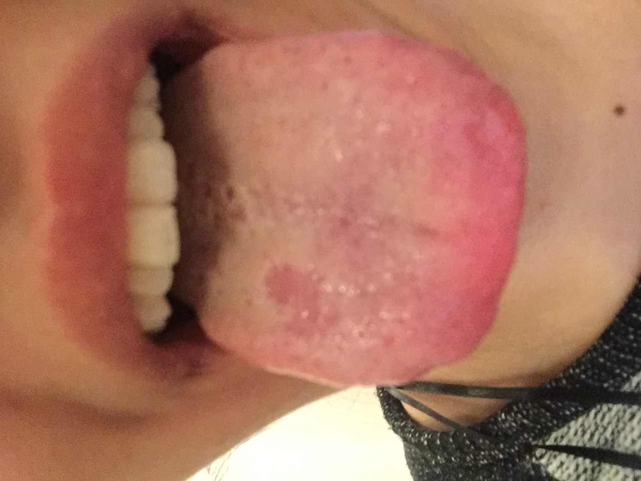 Belegte Zunge und Mundgeruch - was kann man dagegen tun? (Alkohol)