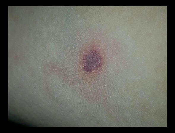 - (Gesundheit, Infekt, Blauer fleck)