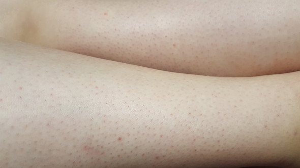 Standig Rote Punkte Auf Den Beinen Egal Bei Was Mit Bild Gesundheit Beauty Haut Standig Rote Punkte Auf Den Beinen Egal Bei Was Mit Bild Gesundheit Beauty Haut