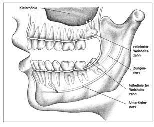 Weisheitszähne - (Zähne, Zahnarzt, Schaden)