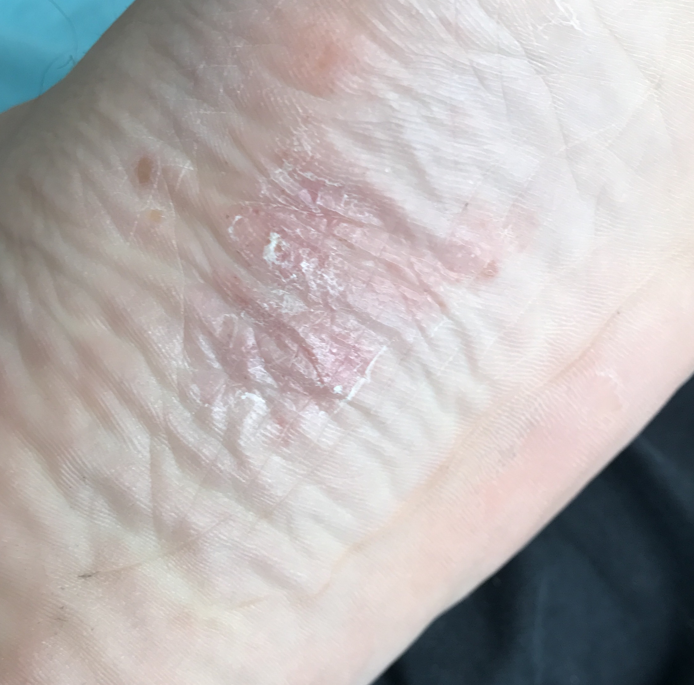 Ich habe so flecken unter dem Fuß bekommen was kann das sein und was kann ich dagegen tun