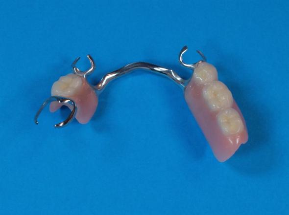 Bild 2 - (Zähne, Zahnarzt, Zahnersatz)