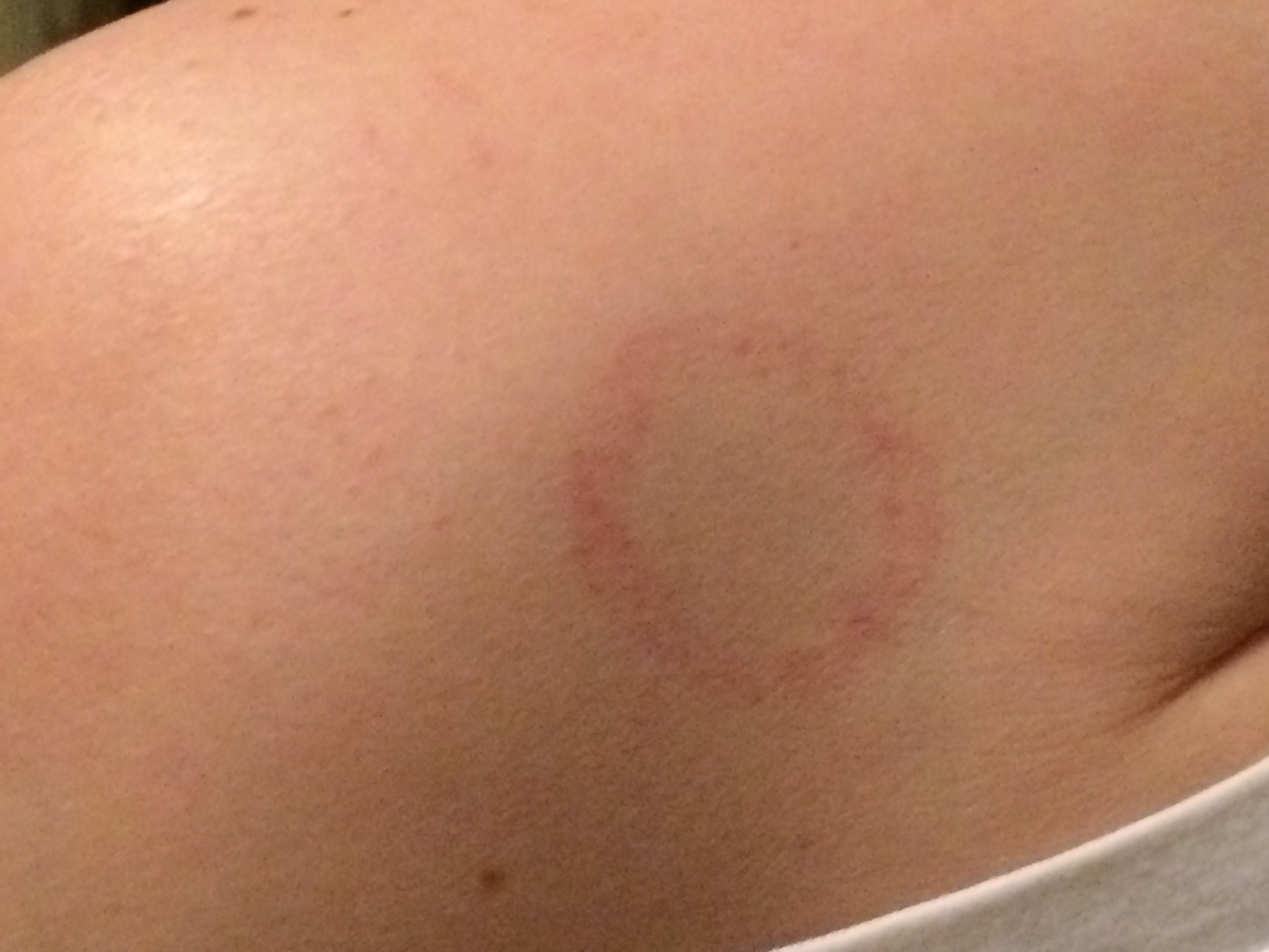 Roter Kreis auf der Haut. Was ist das? (Gesundheit)