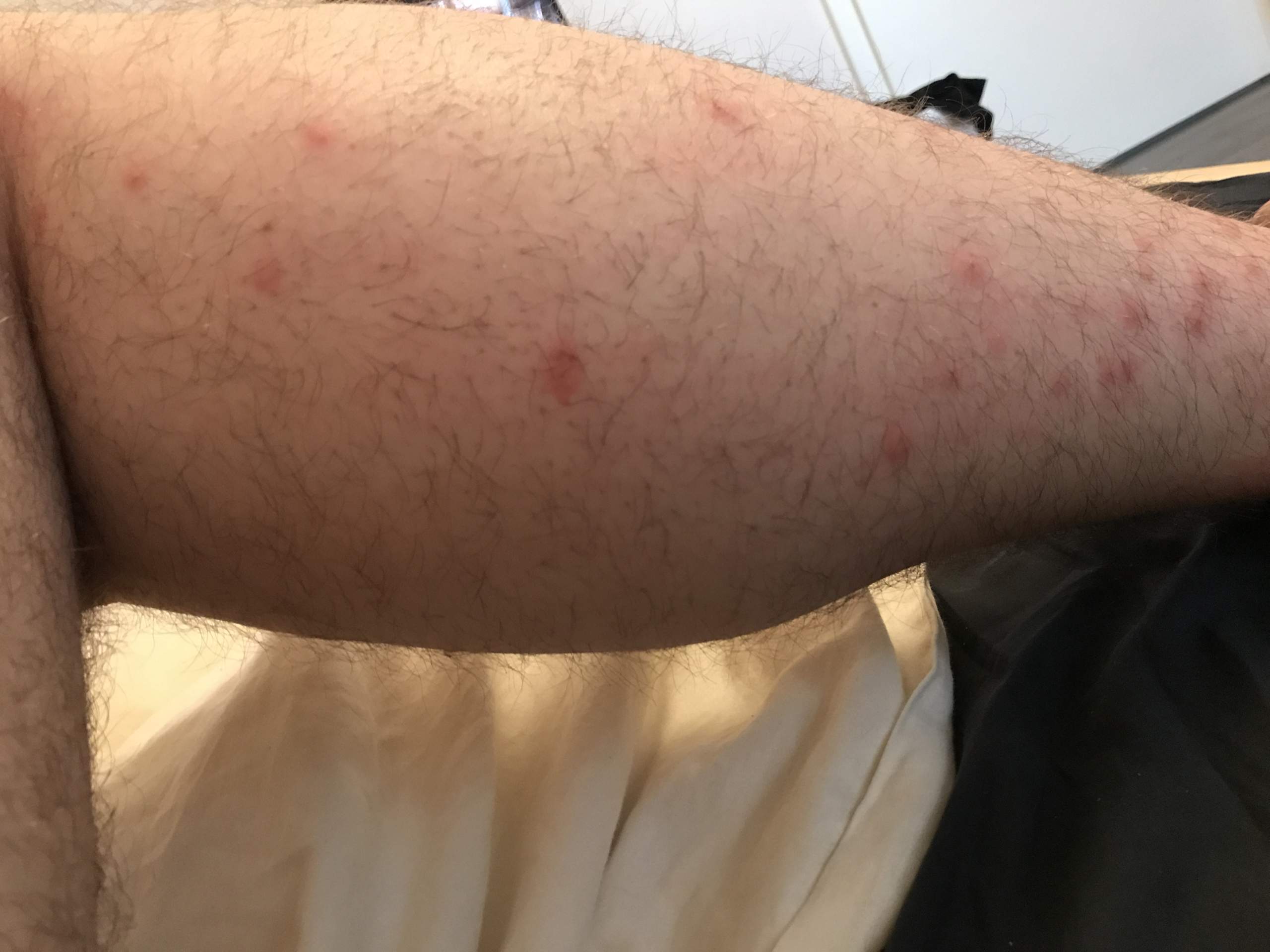 Flohbisse oder doch Bettwanzen? (Insekten, Flöhe, Bisse)