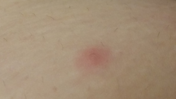 Das ist einer der pickel - (Wanzen, Wanzenbisse)