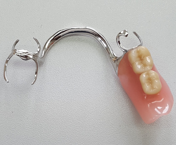 Modellguss - (Zähne, Zahnersatz, Zahnprothese)