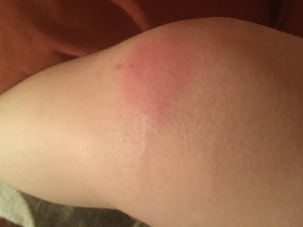 Blutvergiftung Durch Insektenstich Arzt Blutvergiftung Durch Insektenstich Arzt