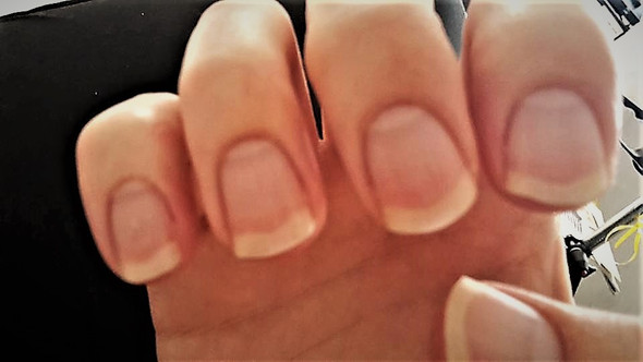 Nagel Wachsen Weiss Nach Gesundheit Und Medizin Finger Fingernagel