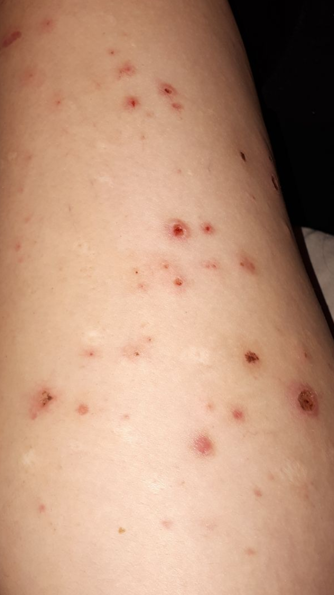 Eextremer Juckreiz und kleine Pickel an den Beinen? (Gesundheit, Haut)