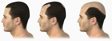 Alopecia androgenetica - (Gesundheit und Medizin, Haare, Haarausfall)