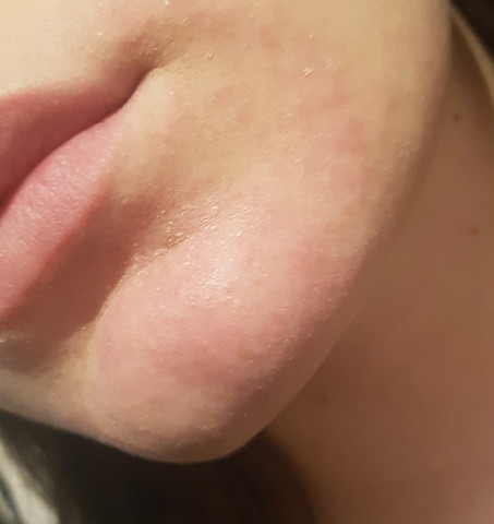 Ausschlag Seit Wochen Am Kinn Gesundheit Und Medizin Haut Rotung Ausschlag Seit Wochen Am Kinn Gesundheit Und Medizin Haut Rotung