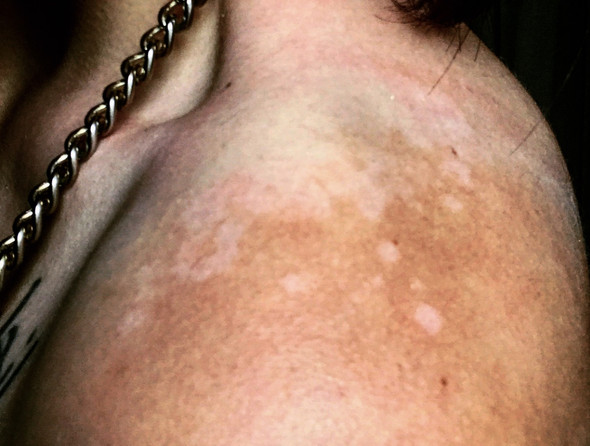 - (Gesundheit und Medizin, Weißfleckenkrankheit, Vilitigo )