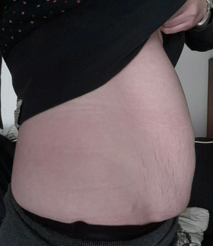 Blahbauch Oder Doch Etwas Schlimmeres Gesundheit Und Medizin Sport Und Fitness Angst Blahbauch Oder Doch Etwas Schlimmeres Gesundheit Und Medizin Sport Und Fitness Angst