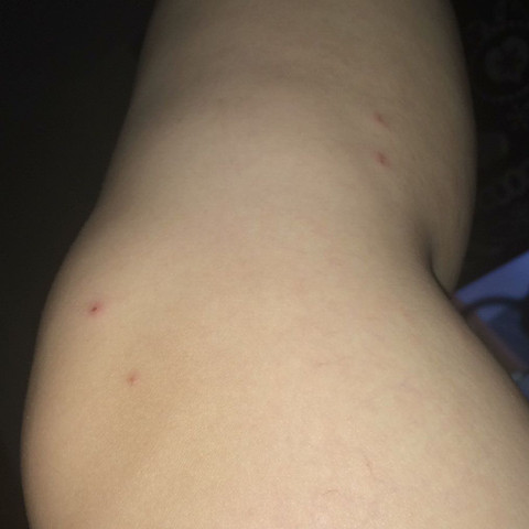 - (Gesundheit und Medizin, Dermatologie, Krätze)