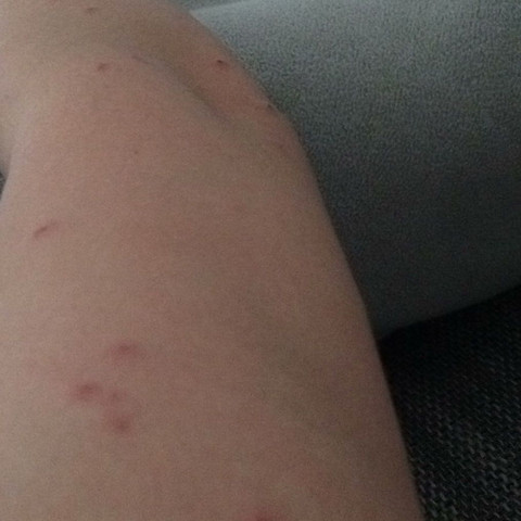 - (Gesundheit und Medizin, Dermatologie, Krätze)