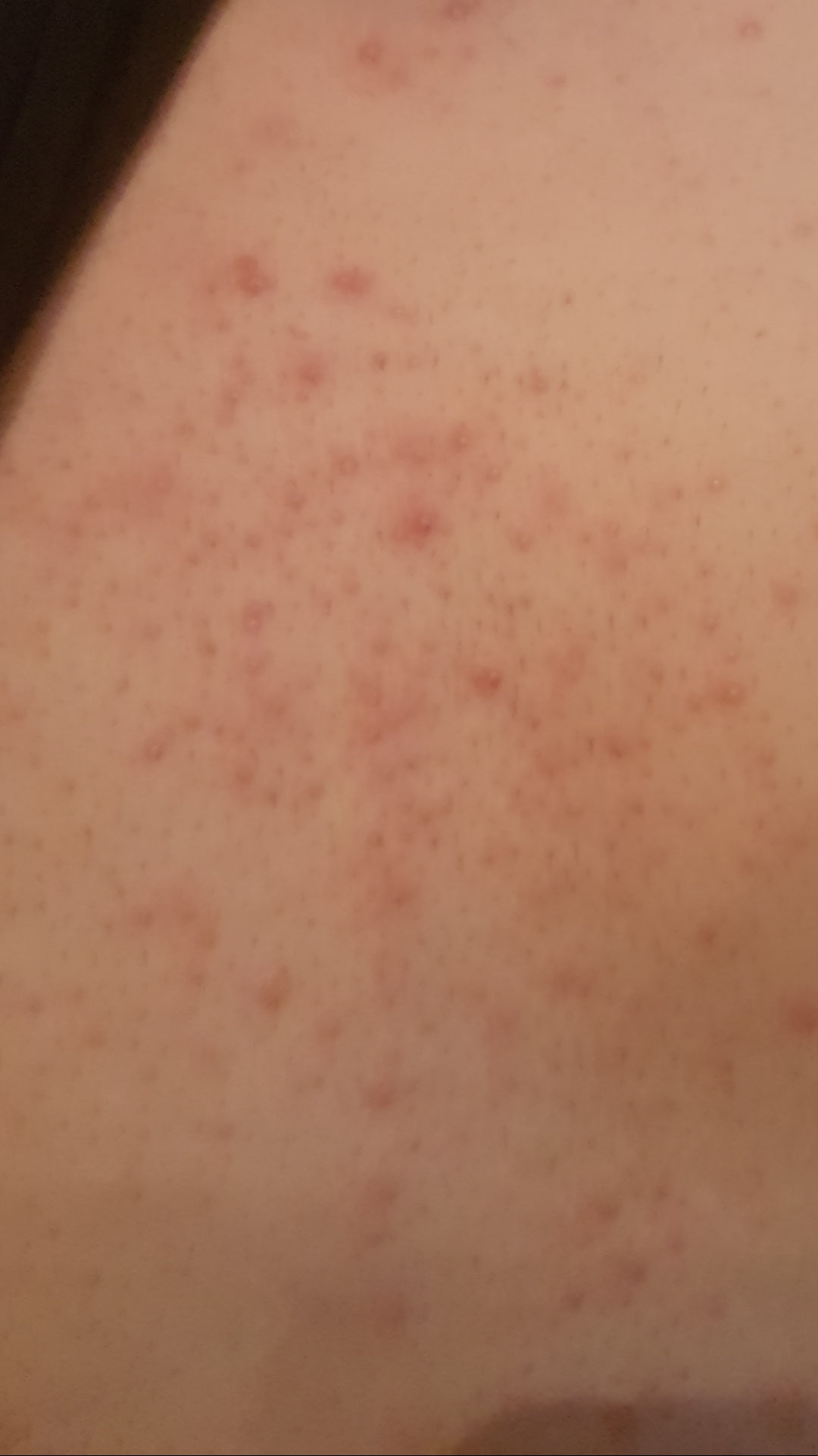 Sehr viele Pickel nach Wachsen im Brustbereich , Was tun Sehr viele Pickel nach Wachsen im Brustbereich , Was tun