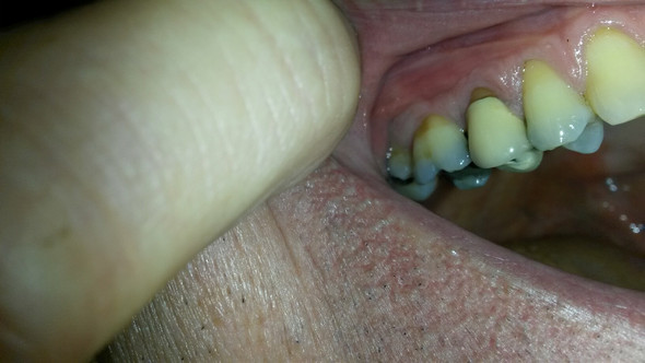  - (Zähne, Zahnfleischentzündung)