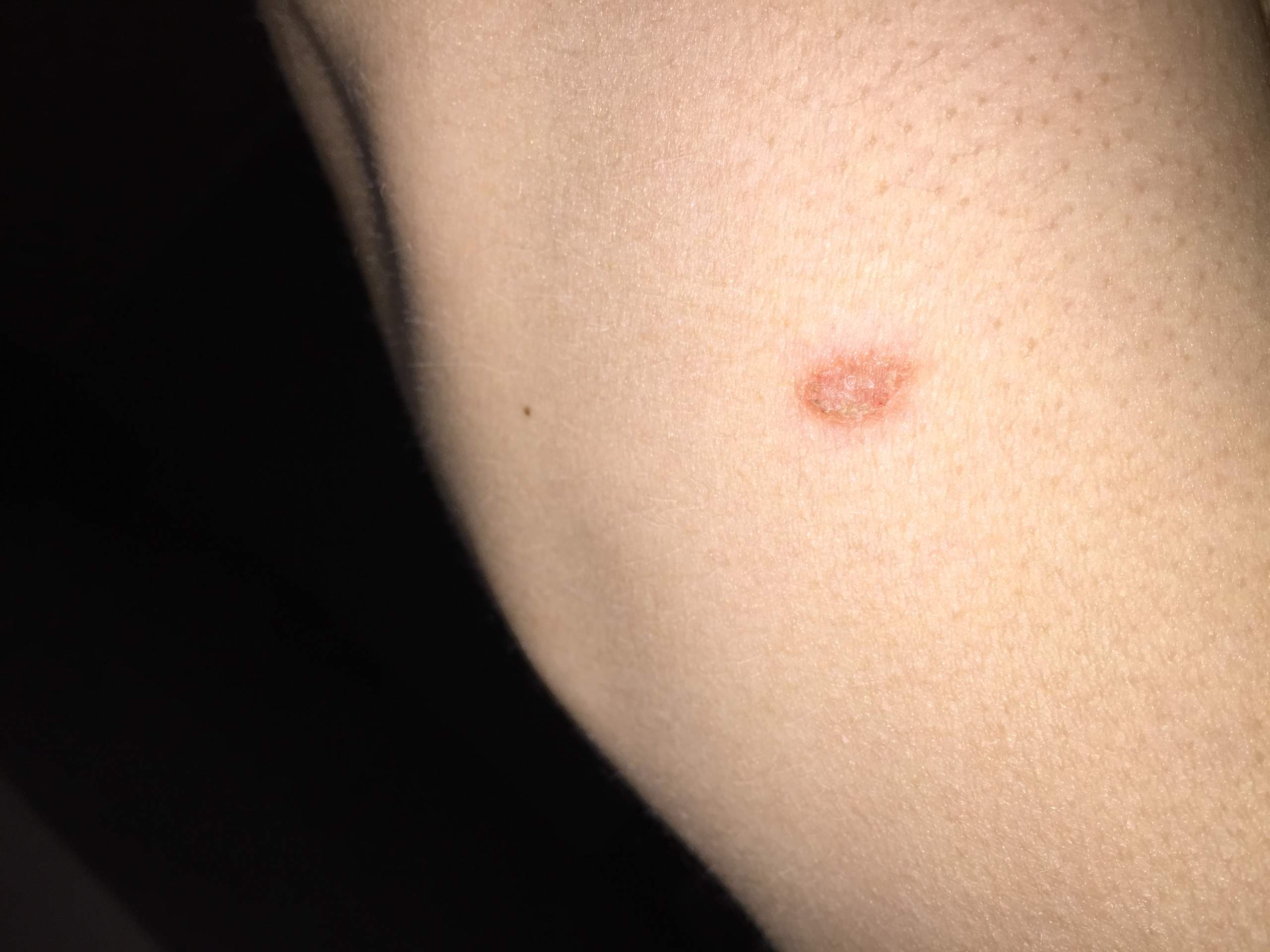 Ich habe hauptsächlich am Bein so rote juckende stellen (fühlen sich an wie trockene Haut)was