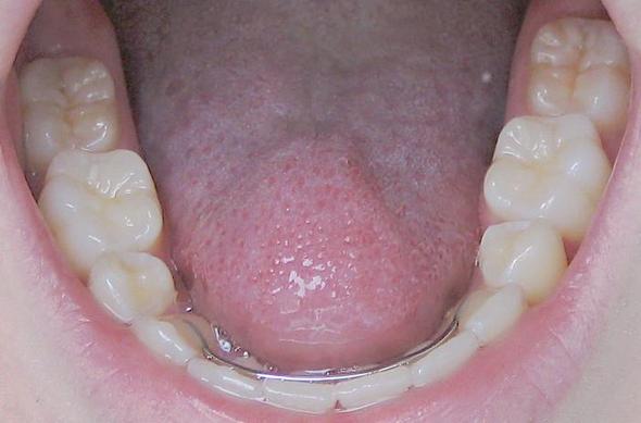 Unterkiefer ohne 5er - (Zähne, Zahnspange)