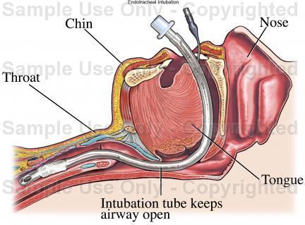 Intubation - (Krankenhaus, Operation, Kopfschmerzen)