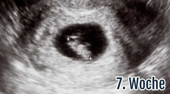 Kein Embryo zu sehen, 7ssw, sondern nur längliche Fruchthöhle Kein Embryo zu sehen, 7ssw, sondern nur längliche Fruchthöhle