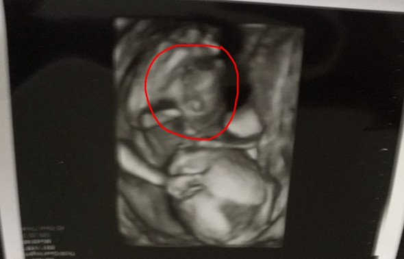 16 Ssw 3d Ultraschall Kopf Sieht Komisch Aus Schwangerschaft Baby