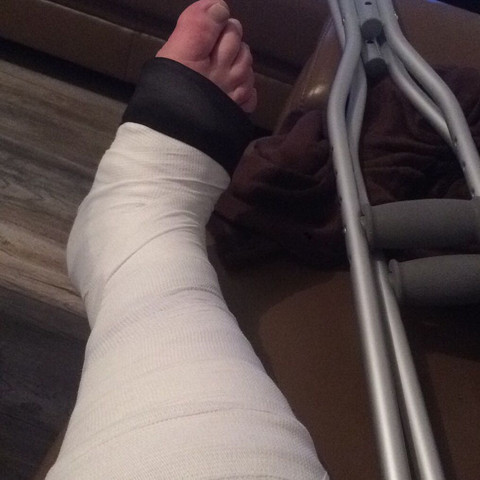 Gips fuß Gips Fuß