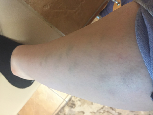 Blaue Flecken Und Schmerzen Im Bein Gesundheit Und Medizin Beine Thrombose Blaue Flecken Und Schmerzen Im Bein Gesundheit Und Medizin Beine Thrombose