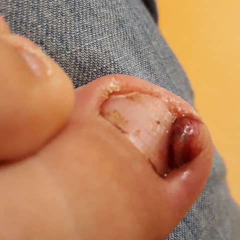 Wildes Fleisch Operation Gesundheit Und Medizin Fusse Entzundung Wildes Fleisch Operation Gesundheit Und Medizin Fusse Entzundung