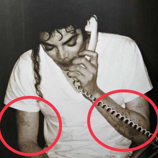 Warum Hat Sich Michael Jackson Weis Gemacht