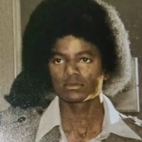 Vitiligo 3 - (Michael Jackson, Hautfarbe)