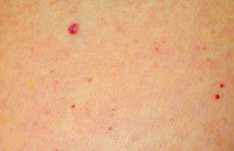 Rote Punkte Am Korper Was Ist Das Gesundheit Und Medizin Ausschlag
