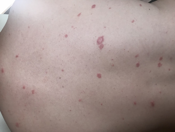 Komische Rote Flecken Am Bauch Rucken Gesundheit Und Medizin Haut Rot Komische Rote Flecken Am Bauch Rucken Gesundheit Und Medizin Haut Rot