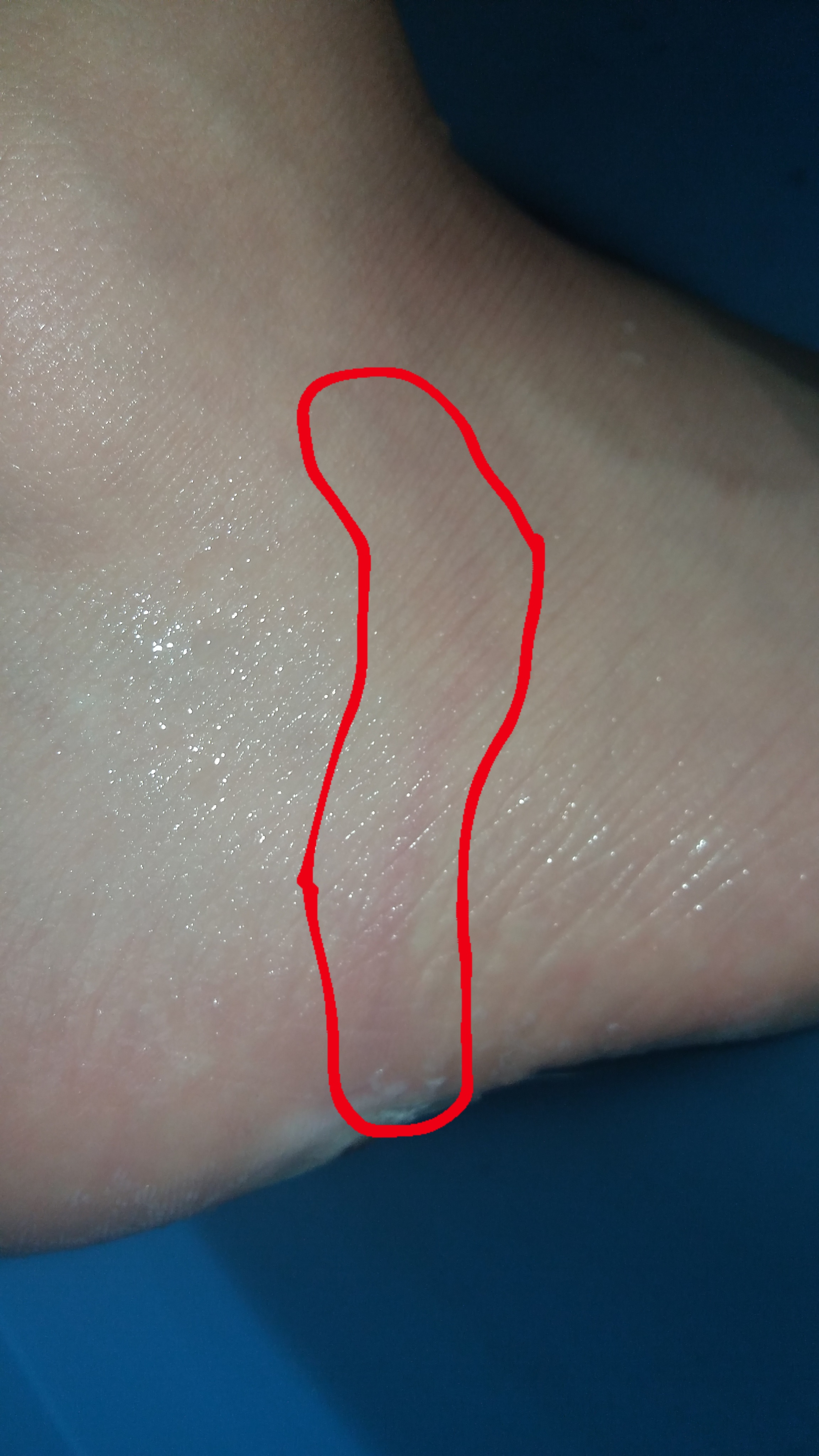 Was ist das für ein komischer roter Strich an meinem Fuß? (Gesundheit und Medizin, Schmerzen