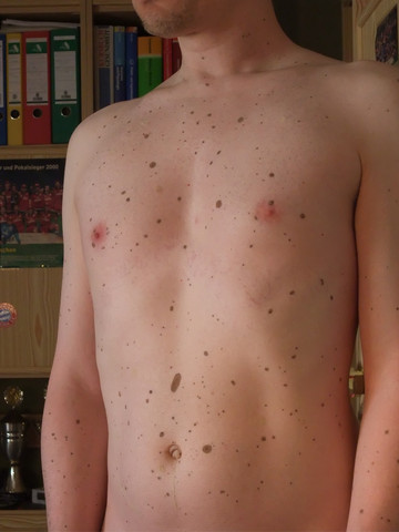 Bauch Ok Oder Sind Das Zu Viele Muttermale Krankheit Haut Tattoo Bauch Ok Oder Sind Das Zu Viele Muttermale Krankheit Haut Tattoo