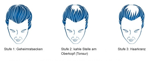 glatzen erblich bedingter haarausfall