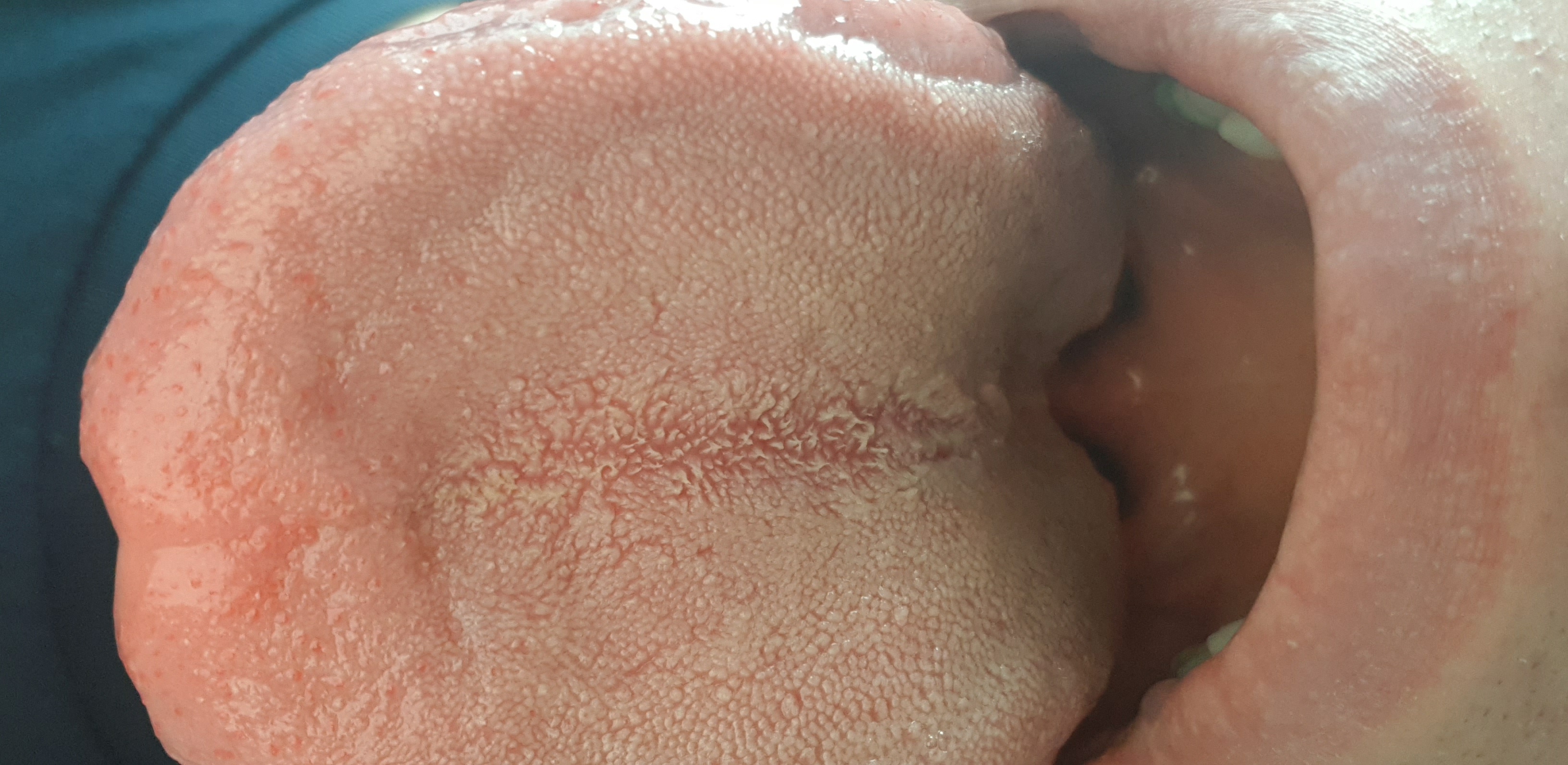 Gelber/weißer Rachen und weiße Zungenpapillen - kennt das jemand ...