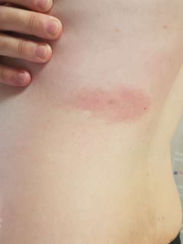 Roter Flecken Am Rucken Borreliose Gesundheit Und Medizin Krankheit Rot Roter Flecken Am Rucken Borreliose Gesundheit Und Medizin Krankheit Rot