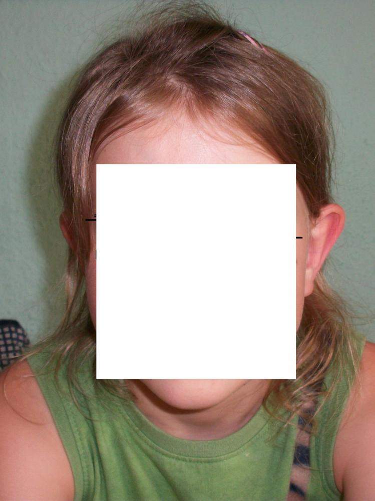 wie blöde sprüche wegen abstehendne ohren kontern? (Ohr, Segelohren, Abstehende Ohren) wie blöde sprüche wegen abstehendne ohren kontern? (Ohr, Segelohren, Abstehende Ohren)